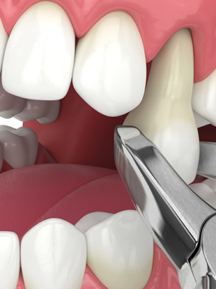 Everything You Need To Know About Tooth Extraction
