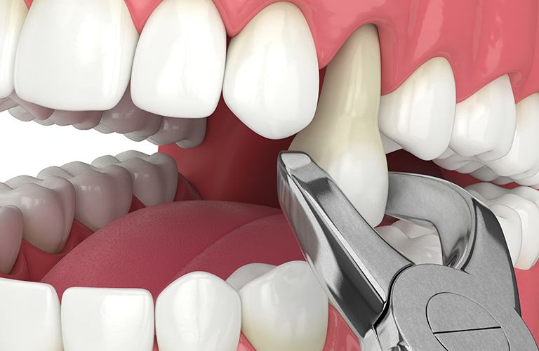 Everything You Need To Know About Tooth Extraction