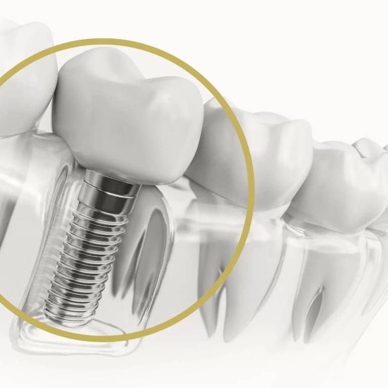 6 Foods To Avoid After Dental Implant Surgery